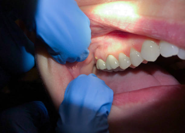 Best Emergency Dental Care for Abscessed Tooth in Cordaville, MA